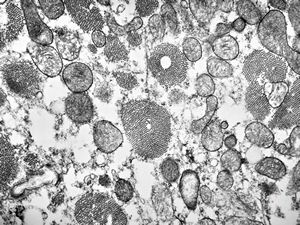 M,15y. | clin. susp. cardiomyopathy- left ventricle